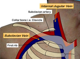 subclavian vein central line landmarks